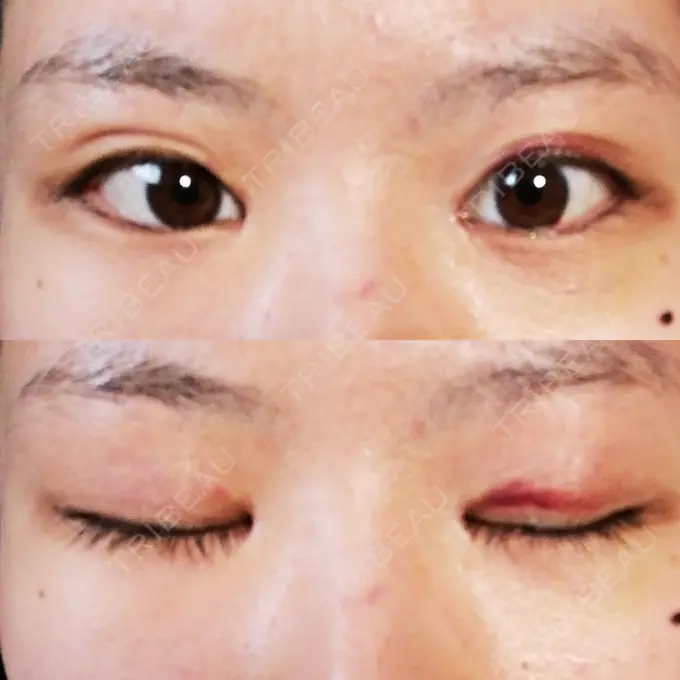 目頭切開 / 目尻切開 / 水光注射（ハリ・美肌） エートップ美容整形外科 DAY 15 メイン用