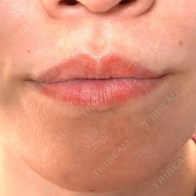 アートメイク（唇） エースクリニック 大阪梅田HEPナビオ院 DAY 15 メイン用