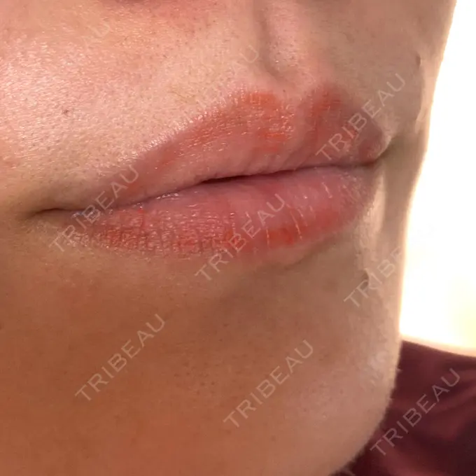 アートメイク（唇） エースクリニック 大阪梅田HEPナビオ院 DAY 15 メイン用