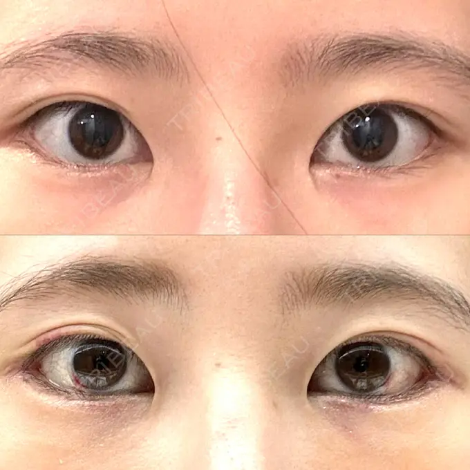 タレ目形成・グラマラスライン（切開） 銀座マイアミ美容外科 DAY 8 メイン用