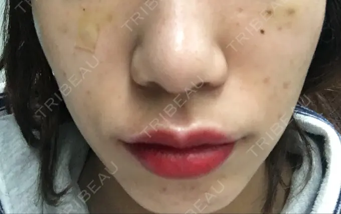 ほくろ・いぼ切除（肌） / 白玉点滴・注射 / プラセンタ注射 / その他（肌） / 美肌レーザー / ほくろ・いぼ除去レーザー（肌） / ニキビ治療 YOU&I皮膚科 明洞店 DAY 3 メイン用