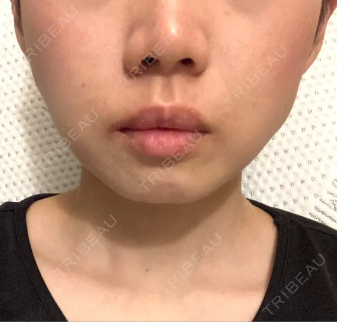 ボトックス（エラ・小顔） 仙台TAクリニック AFTER メイン用