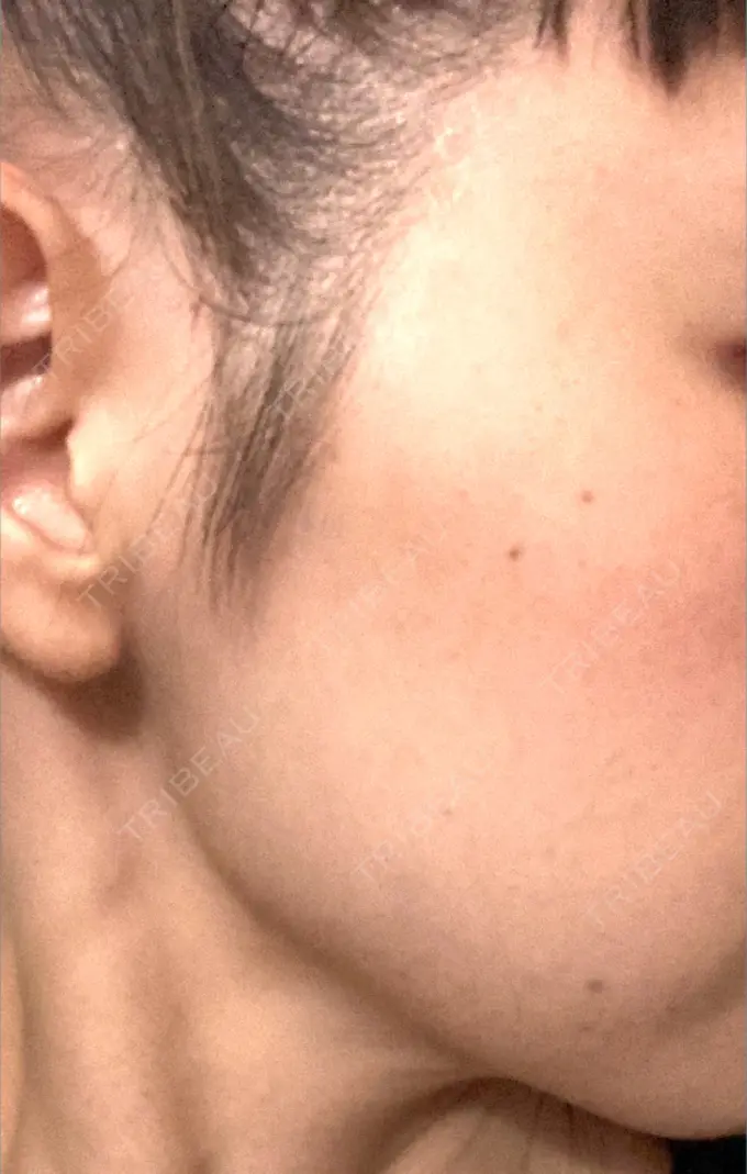 ボトックス（エラ・小顔） 仙台TAクリニック DAY 14 メイン用