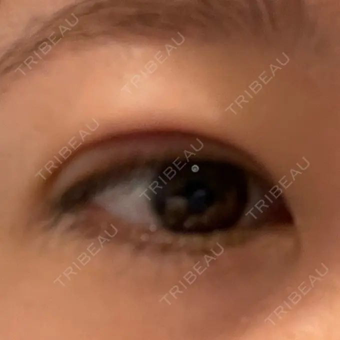 二重埋没 yuzawa clinic DAY 1 メイン用