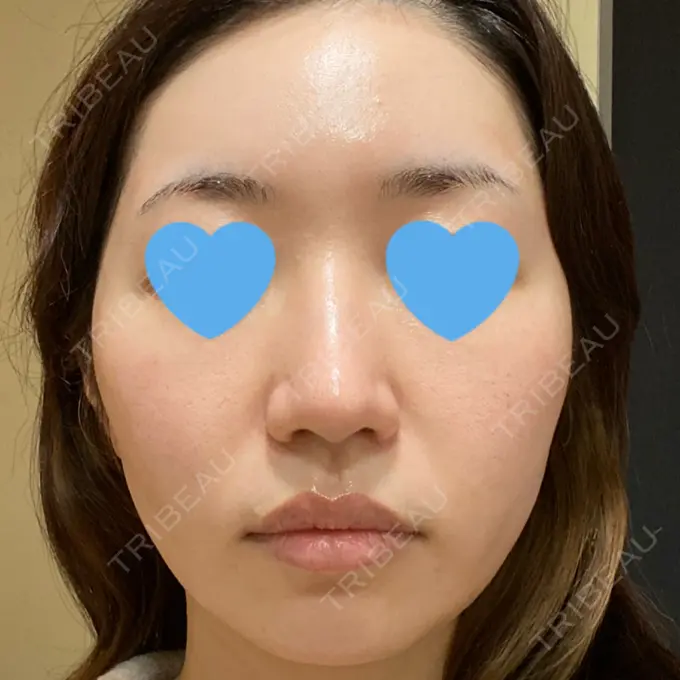 ポテンツァ LOUIS CLINIC 二子玉川院【ルイクリニック】 DAY 6 メイン用