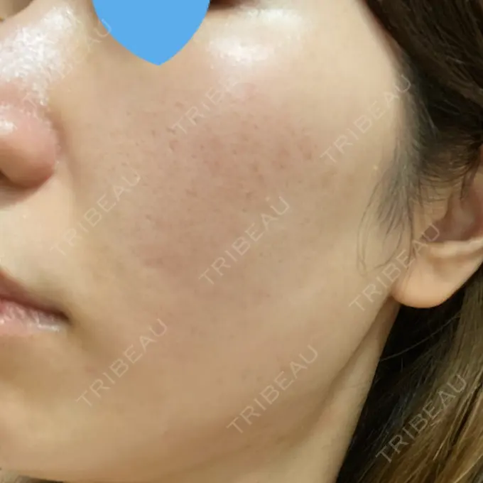 ポテンツァ LOUIS CLINIC 二子玉川院【ルイクリニック】 DAY 6 メイン用