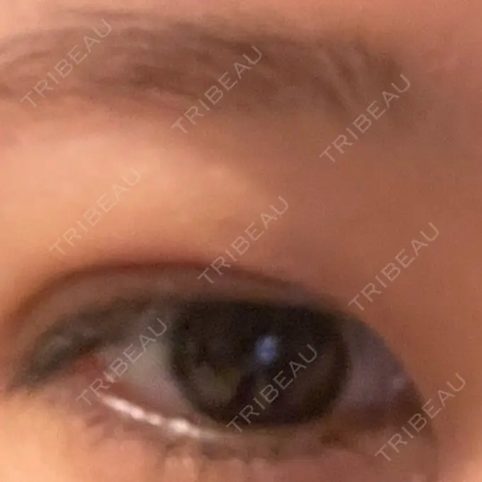 二重埋没 yuzawa clinic DAY 2 メイン用