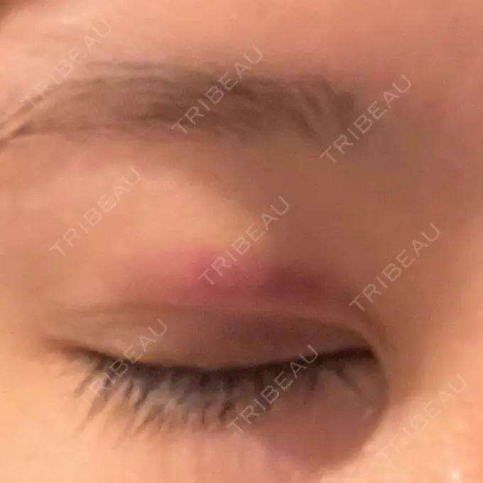 二重埋没 yuzawa clinic DAY 2 メイン用