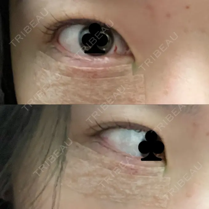 下まぶたたるみ取り / 下まぶたの脂肪取り / その他（目元） 吉井クリニック DAY 0 メイン用