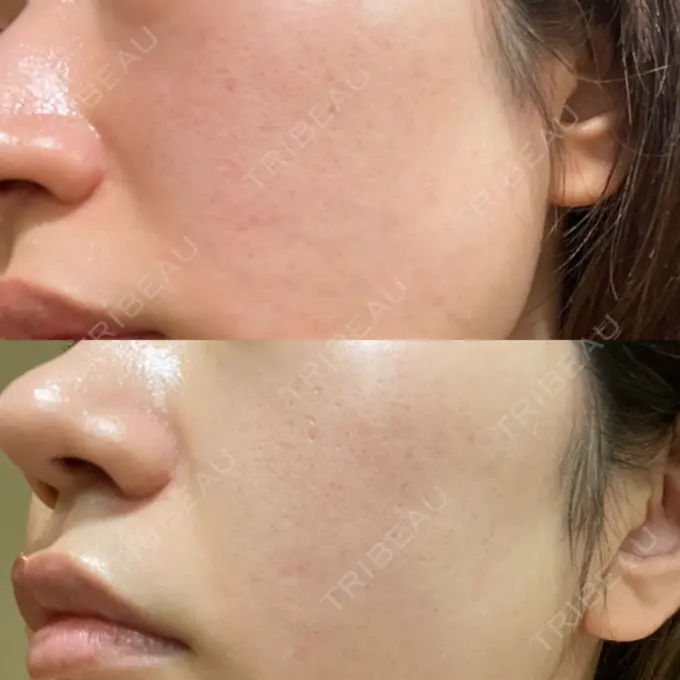 ポテンツァ LOUIS CLINIC 二子玉川院【ルイクリニック】 DAY 7 メイン用