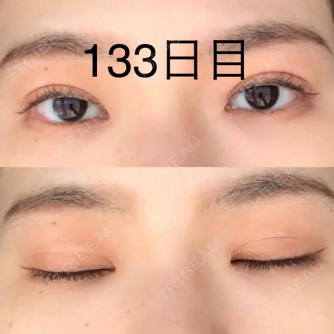 二重切開 / 上まぶたたるみ取り / 上まぶたの脂肪取り 城本クリニック 豊橋院 AFTER メイン用