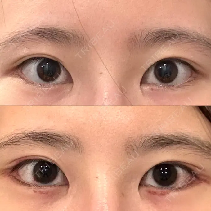 タレ目形成・グラマラスライン（切開） 銀座マイアミ美容外科 DAY 10 メイン用