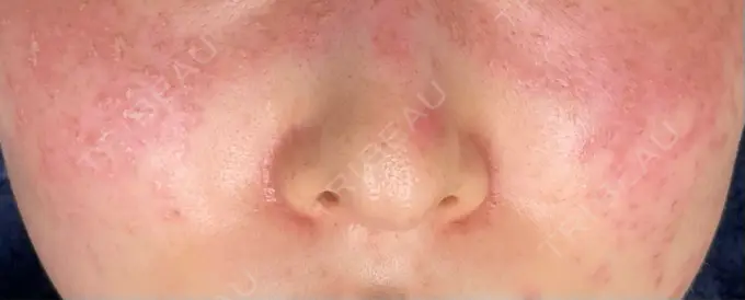 ピコスポット LOUIS CLINIC 二子玉川院【ルイクリニック】 DAY 0 メイン用