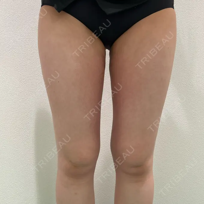 脂肪吸引（脚） Mods Clinic（モッズクリニック） 名古屋院 DAY 88 メイン用