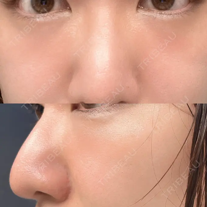 クマ治療 吉井クリニック DAY 17 メイン用