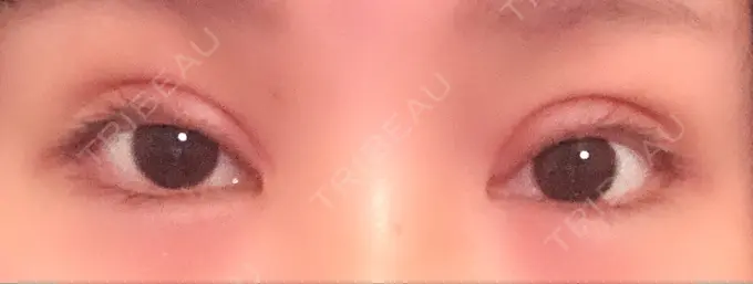 二重切開 / 眼瞼下垂（切開） / 目尻切開 / タレ目形成・グラマラスライン（切開） / 前額リフト レアート整形外科 DAY 9 メイン用