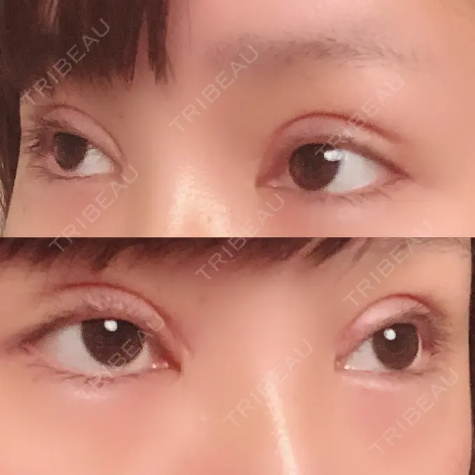 二重切開 / 眼瞼下垂（切開） / 目尻切開 / タレ目形成・グラマラスライン（切開） / 前額リフト レアート整形外科 DAY 9 メイン用