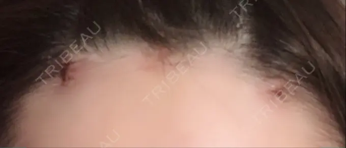 二重切開 / 眼瞼下垂（切開） / 目尻切開 / タレ目形成・グラマラスライン（切開） / 前額リフト レアート整形外科 DAY 9 メイン用