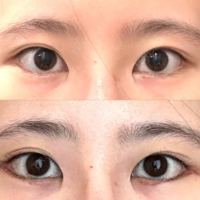 タレ目形成・グラマラスライン（切開） 銀座マイアミ美容外科 DAY 12 メイン用