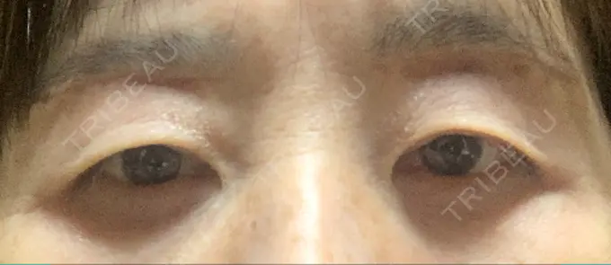 眉下切開 みずほクリニック DAY 21 メイン用