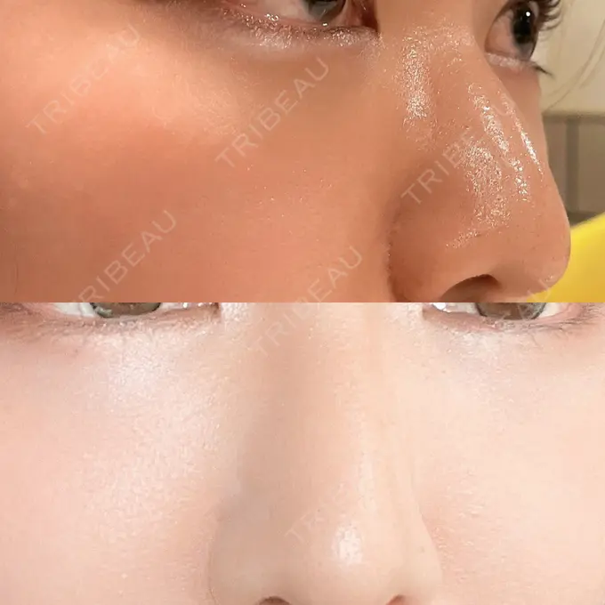 クマ治療 吉井クリニック DAY 17 メイン用