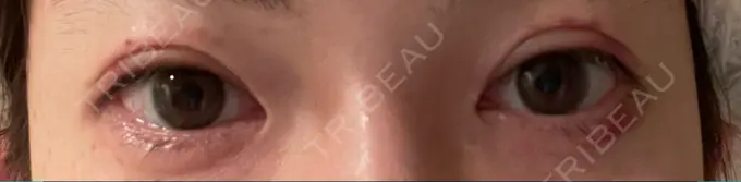 二重切開 有楽町高野美容クリニック DAY 12 メイン用