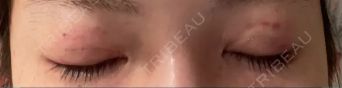 二重切開 有楽町高野美容クリニック DAY 12 メイン用