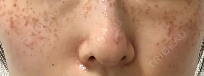 ピコスポット LOUIS CLINIC 二子玉川院【ルイクリニック】 DAY 2 メイン用