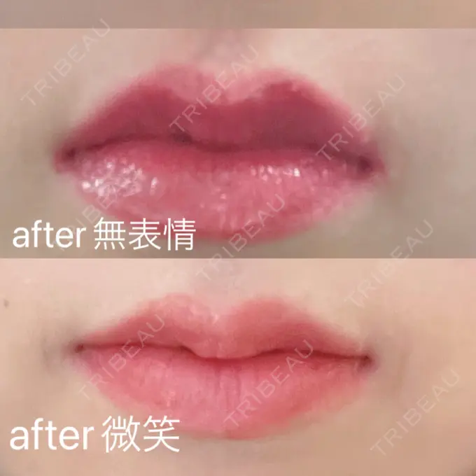 その他（口元） Mavie Beauty Clinic （マヴィービューティークリニック） AFTER メイン用