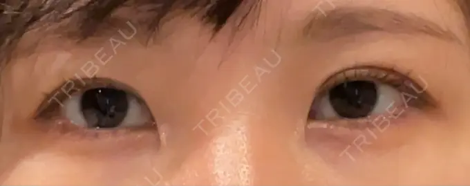 二重埋没 yuzawa clinic DAY 7 メイン用