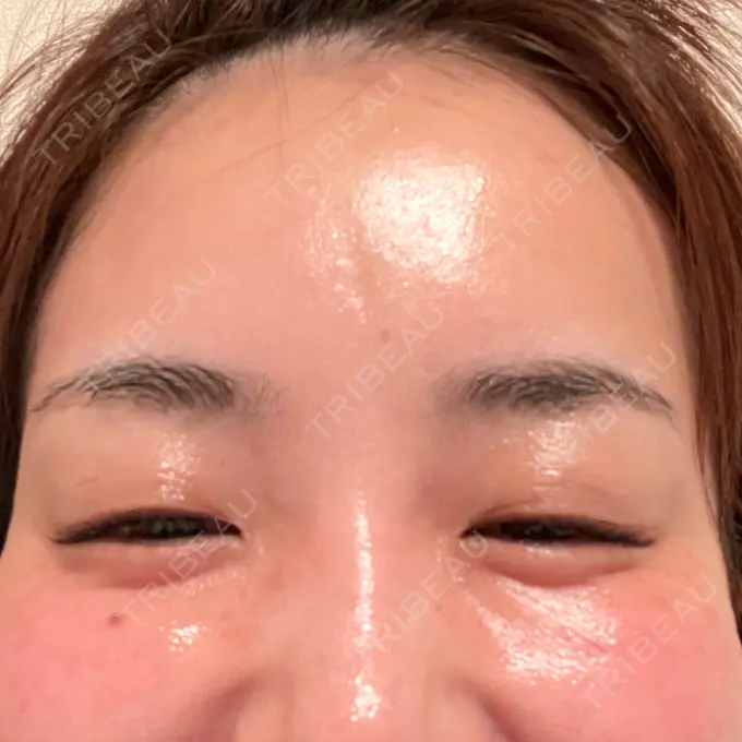 ボトックス（目尻） 湘南美容クリニック 岡山院 DAY 8 メイン用