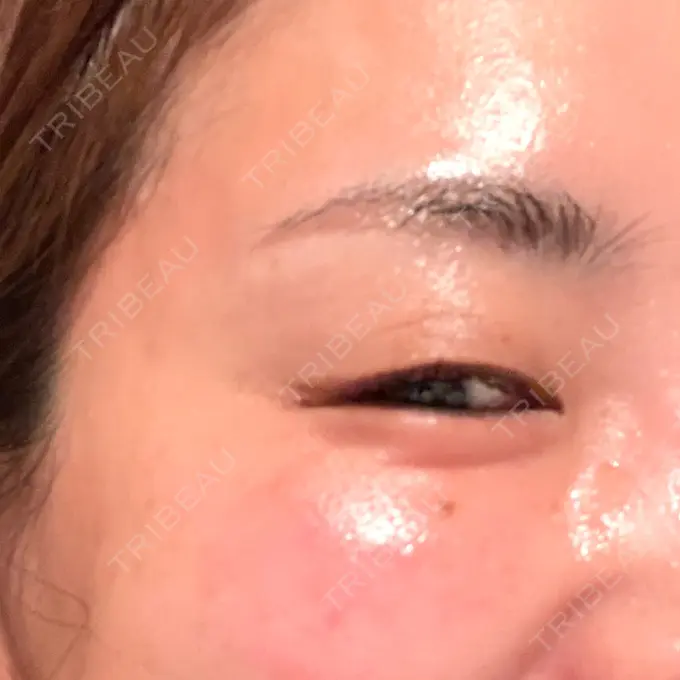 ボトックス（目尻） 湘南美容クリニック 岡山院 DAY 8 メイン用