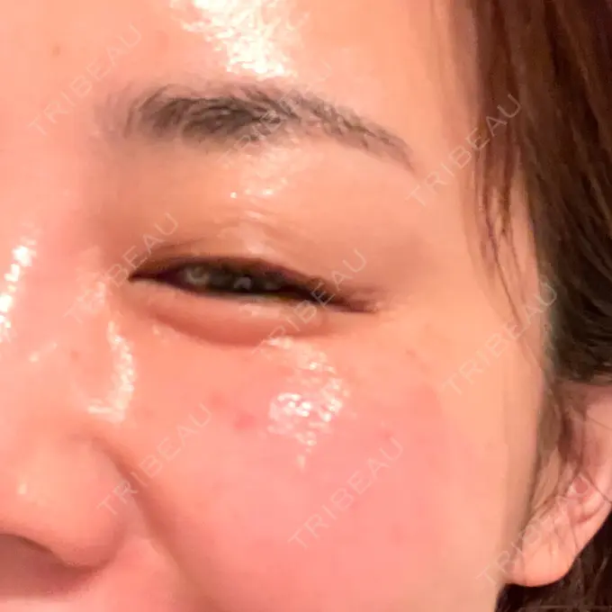 ボトックス（目尻） 湘南美容クリニック 岡山院 DAY 8 メイン用