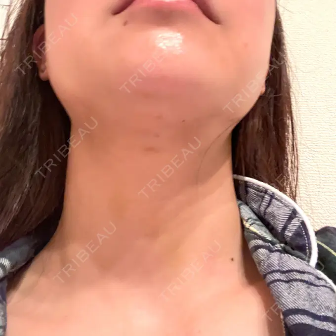 糸リフト / 脂肪吸引（顔） 湘南美容クリニック 岡山院 DAY 8 メイン用