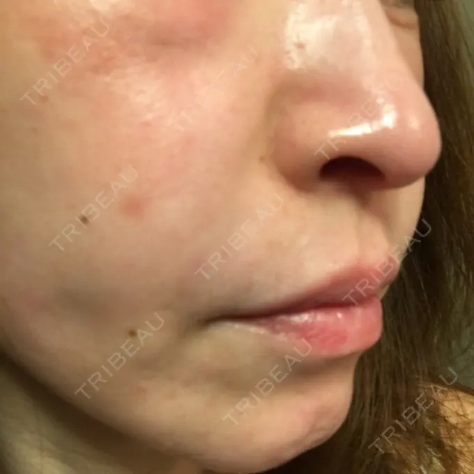 肌ヒアルロン酸注入（たるみ・シワ改善） TCB東京中央美容外科 宇都宮院 DAY 0 メイン用