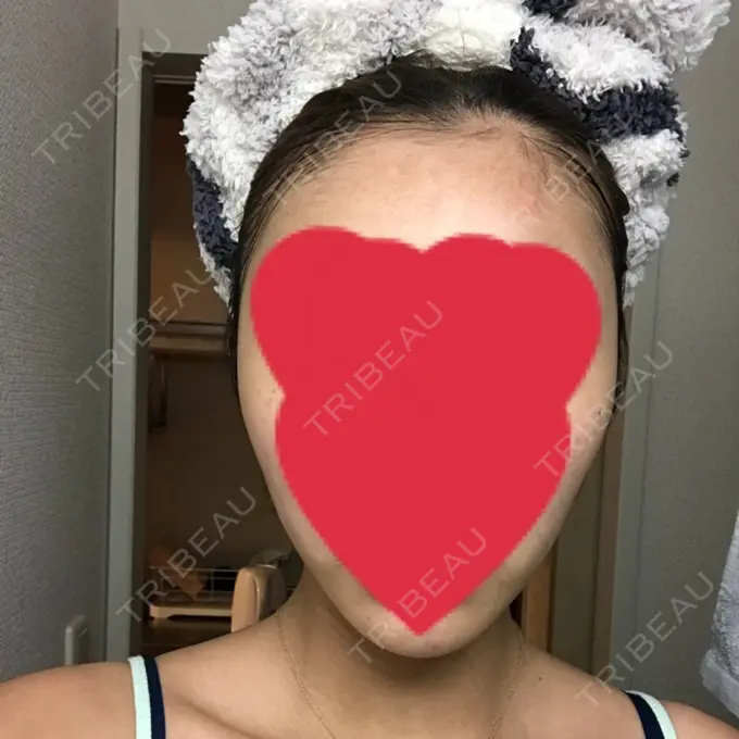 バッカルファット除去 / 脂肪吸引（顔） / 額を丸く / ヒアルロン酸注入（あご） / ボトックス（エラ・小顔） / ヒアルロン酸注入（額） エートップ美容整形外科 DAY 39 メイン用