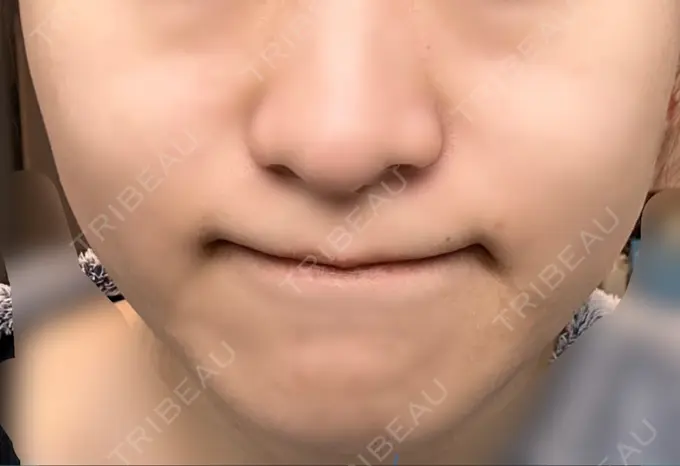 ボトックス（エラ・小顔） / ハイフ（顔） TCB東京中央美容外科 六本木院 DAY 0 メイン用