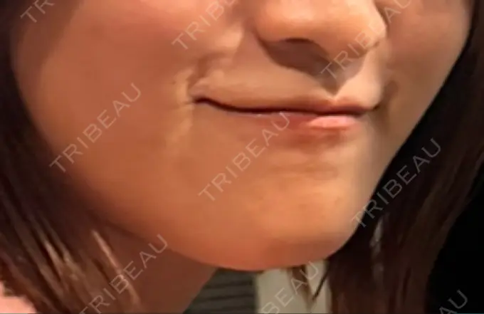 ボトックス（エラ・小顔） / ハイフ（顔） TCB東京中央美容外科 六本木院 DAY 5 メイン用