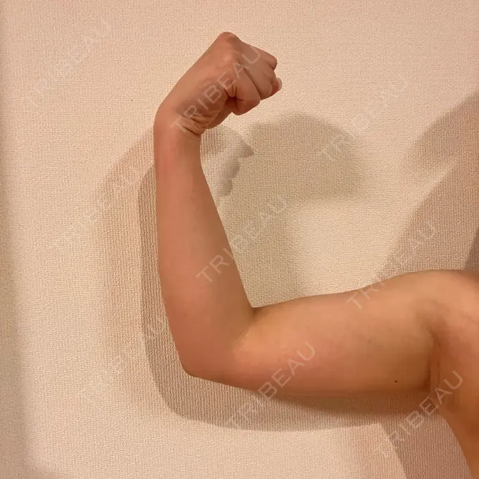 脂肪冷却（二の腕） KOSHOクリニック 本館 DAY 95 メイン用