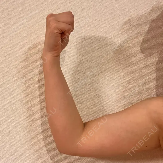 脂肪冷却（二の腕） KOSHOクリニック 本館 DAY 101 メイン用