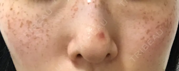 ピコスポット LOUIS CLINIC 二子玉川院【ルイクリニック】 DAY 4 メイン用