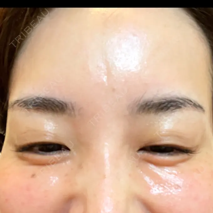 ボトックス（目尻） 湘南美容クリニック 岡山院 AFTER メイン用