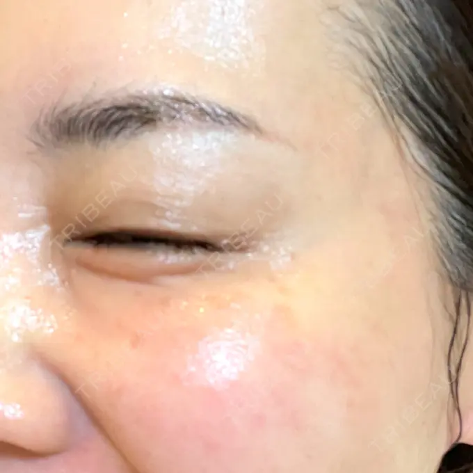 ボトックス（目尻） 湘南美容クリニック 岡山院 DAY 10 メイン用