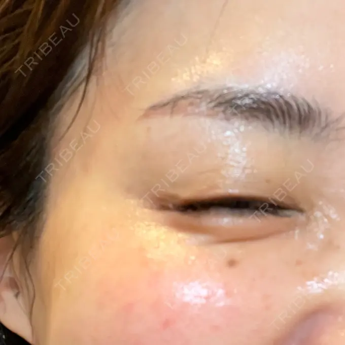 ボトックス（目尻） 湘南美容クリニック 岡山院 DAY 10 メイン用