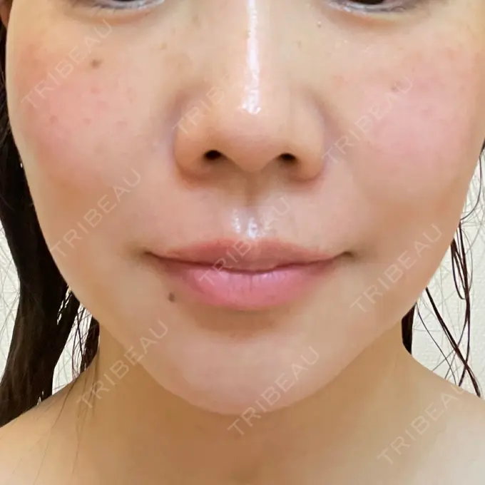 糸リフト / 脂肪吸引（顔） 湘南美容クリニック 岡山院 DAY 10 メイン用