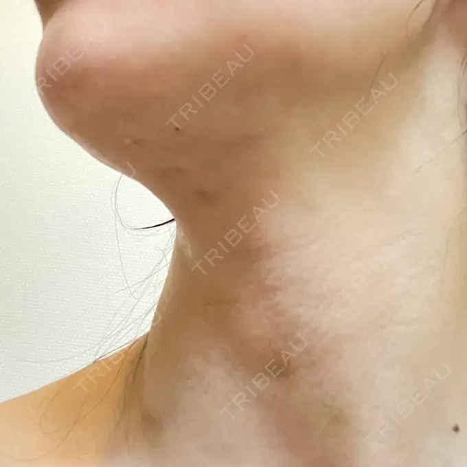 糸リフト / 脂肪吸引（顔） 湘南美容クリニック 岡山院 DAY 10 メイン用