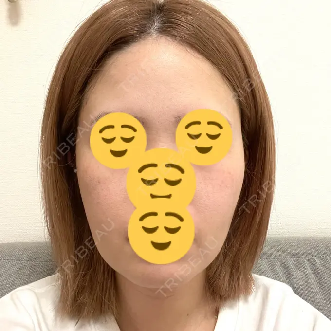 糸リフト / 脂肪吸引（顔） / 脂肪注入（目の下） WOM CLINIC GINZA （ワム クリニック ギンザ） AFTER メイン用