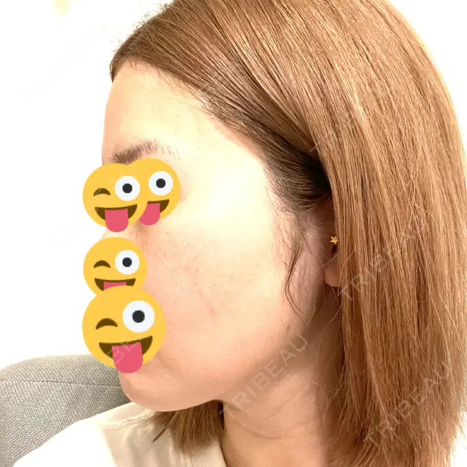 糸リフト / 脂肪吸引（顔） / 脂肪注入（目の下） WOM CLINIC GINZA （ワム クリニック ギンザ） DAY 64 メイン用