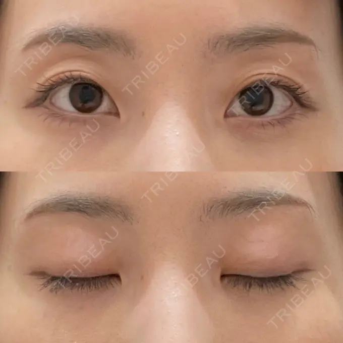 下まぶたの脂肪取り / 脂肪注入（目の下） WOM CLINIC GINZA （ワム クリニック ギンザ） AFTER メイン用