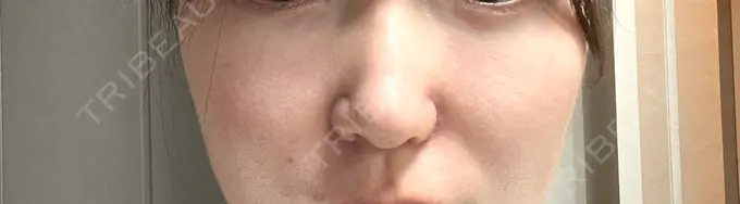 小鼻縮小（切開） / 鼻翼挙上 東京美容医療クリニック 池袋院 DAY 9 メイン用